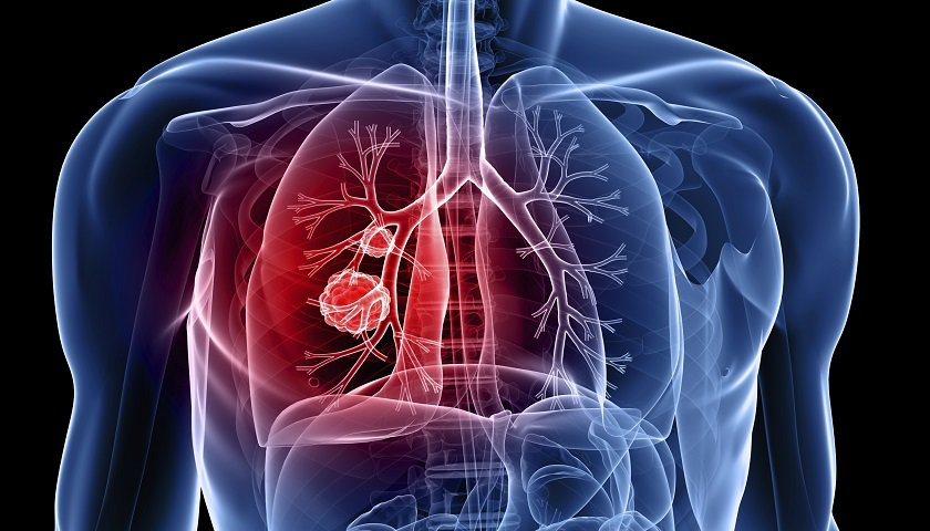Pandemia reduz avanços no combate à tuberculose, diz especialista